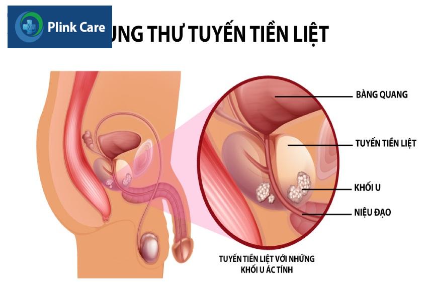 giai đoạn ung thư tuyến tiền liệt
