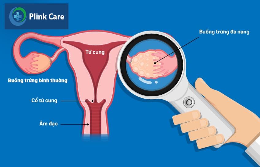 hình minh hoạ buồng trứng đa nang