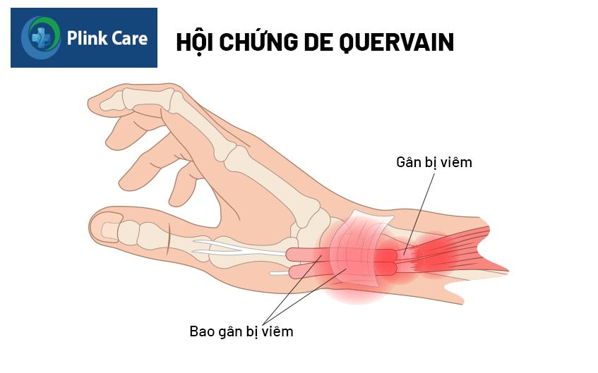 Hội chứng deQuervain