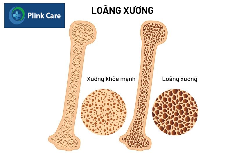 loãng xương