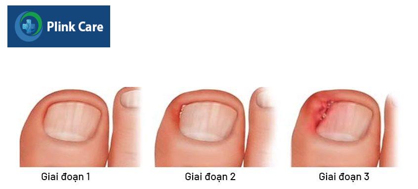 triệu chứng của móng quặp