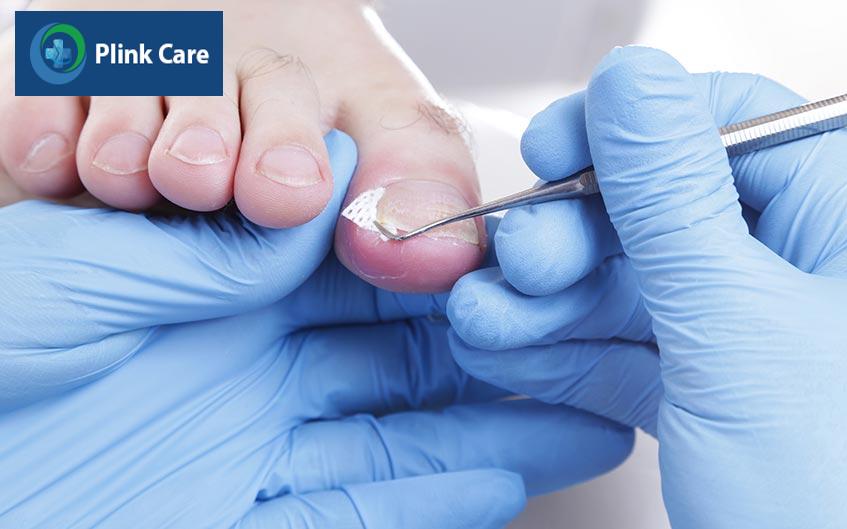 xử lý bị móng quặp