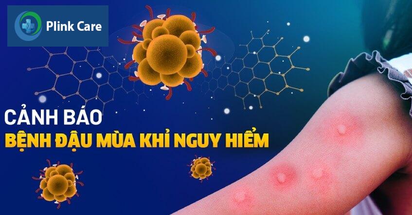 benh dau mua khi la gi