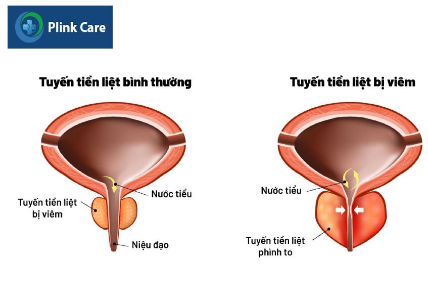 dấu hiệu viêm tuyến tiền liệt