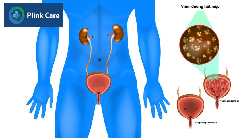 đối tượng có nguy cơ mắc bệnh