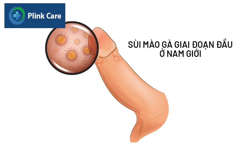 Hình ảnh mắc sùi mào gà giai đoạn đầu ở nam giới