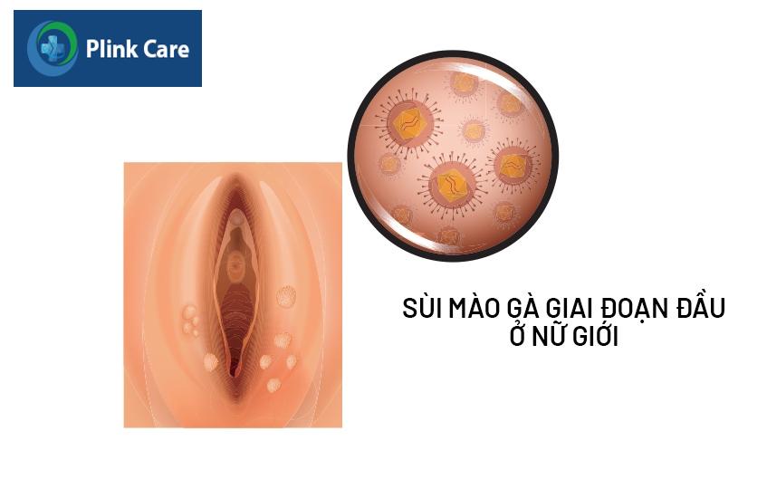 Hình ảnh mắc sùi mào gà giai đoạn đầu ở nữ giới