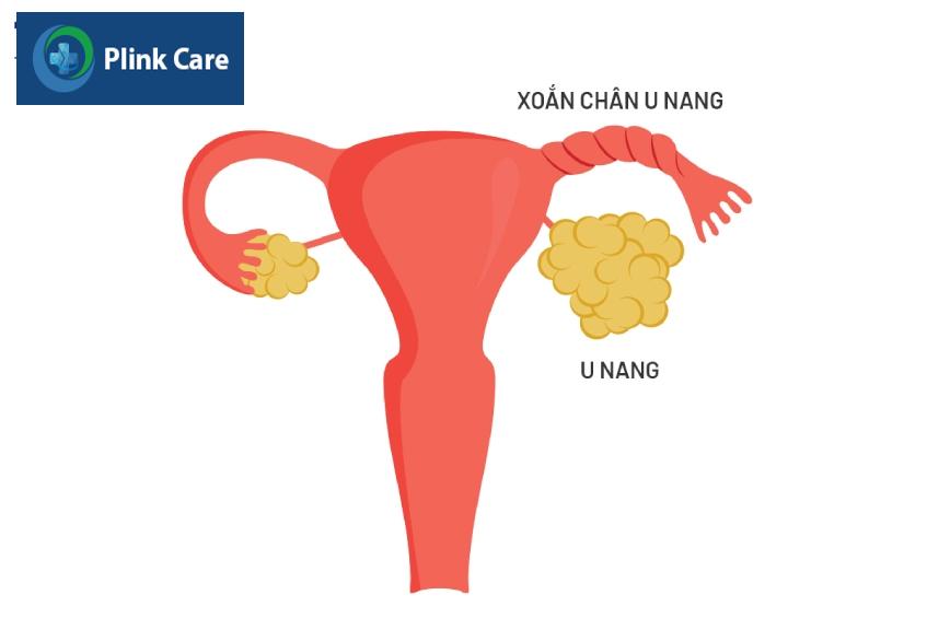 hình ảnh xoắn chân u nang