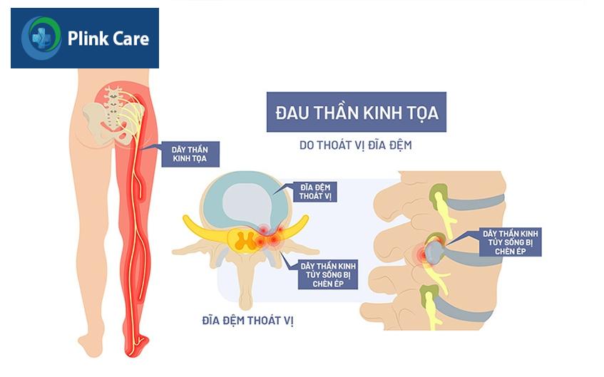 hình minh hoạ đau thần kinh toạ