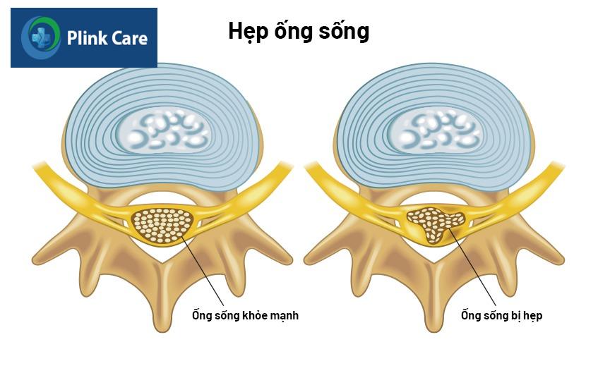 hình minh họa ống sống