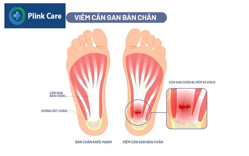 hình minh họa vị trí bị viêm