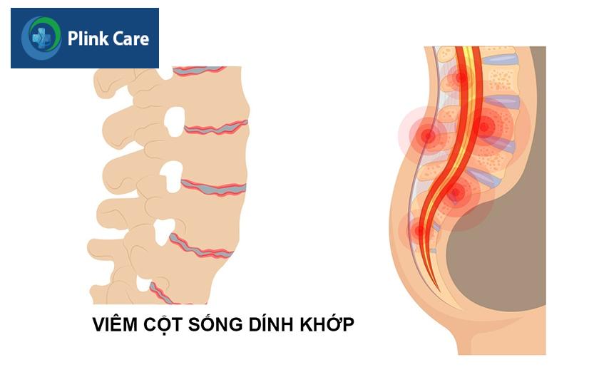 hình minh hoạ viêm cột sống dính khớp