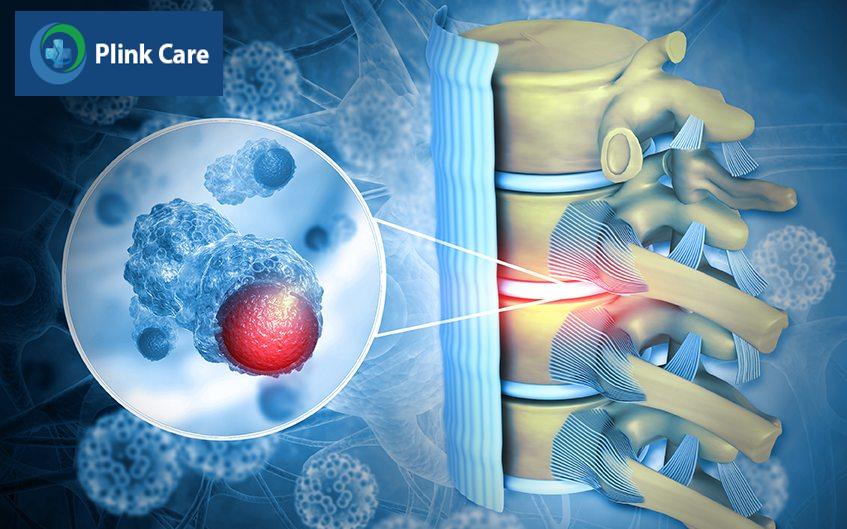 khối tủy phát triển làm hẹp không gian ống