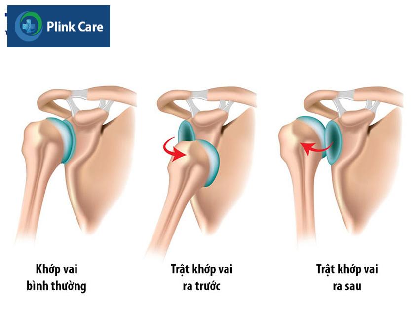 khớp vai bị trật