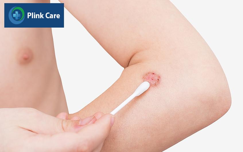 điều trị sùi mào gà ở nam