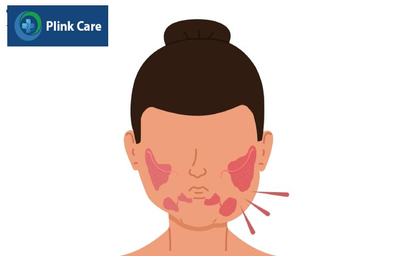 sưng tuyến nước bọt