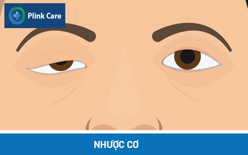 tổng qua về bệnh nhược cơ
