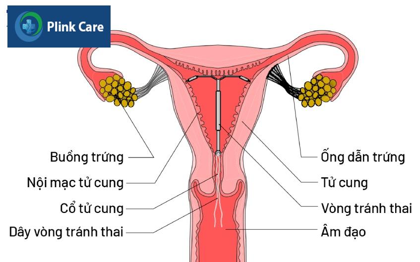 tổng quan về đặt vòng tránh thai