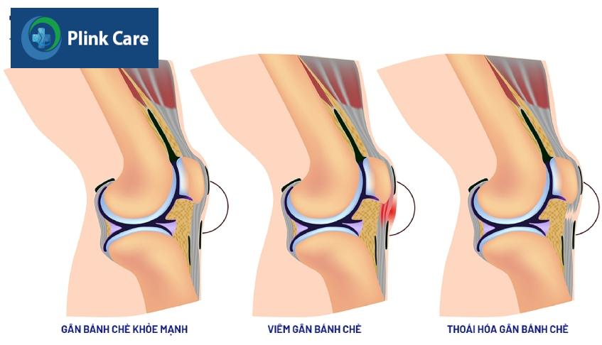 triệu chứng viêm gân