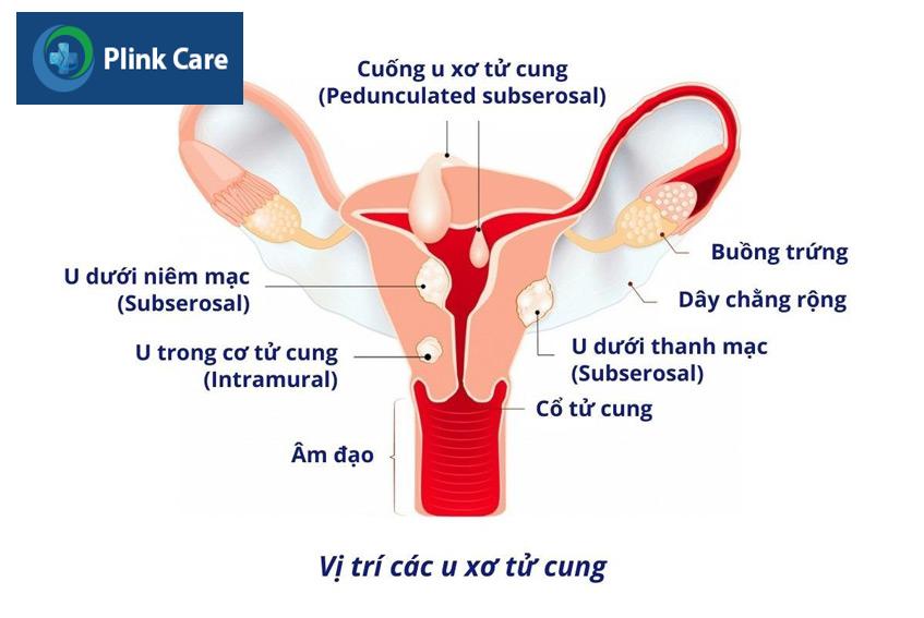 vị trí các khối u xơ trong tử cung