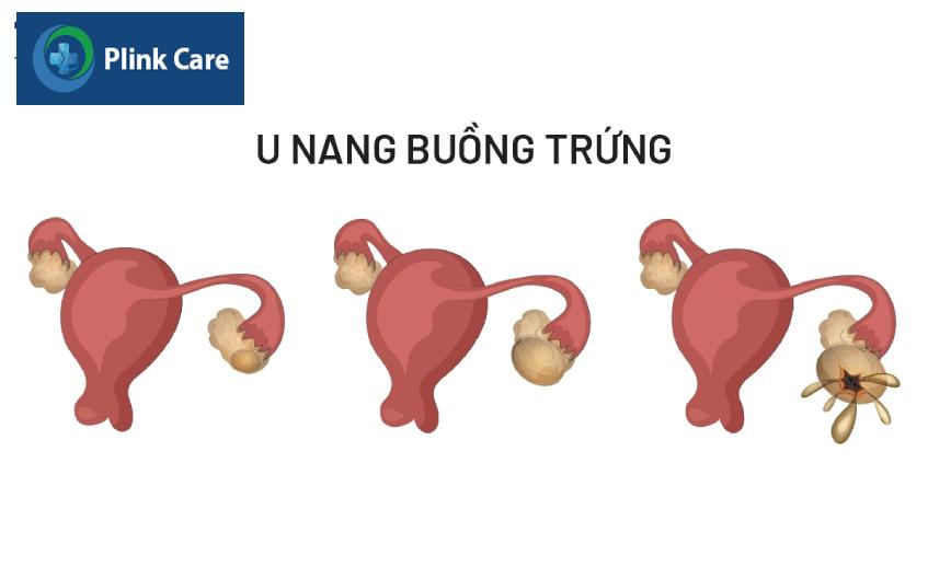 vỡ u nang cũng là nguyên nhân