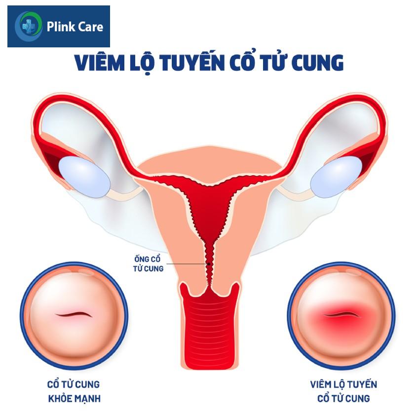 cổ tử cung bị viêm và không bị viêm