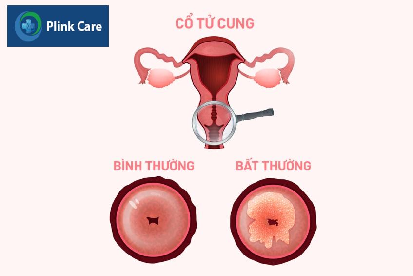 cổ tử cung bình thường và bất thường