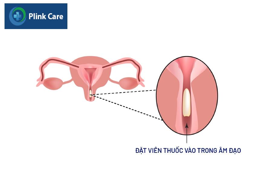 đặt thuốc vòa trong âm đạo