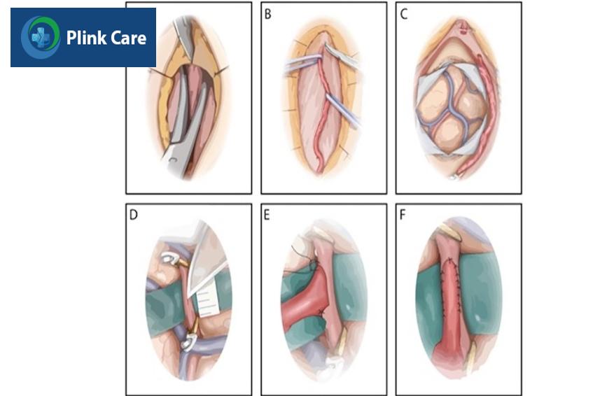 phẫu thuật bắc cầu trực tiếp