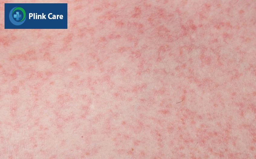 phát ban đỏ là triệu chứng sốt xuất huyết