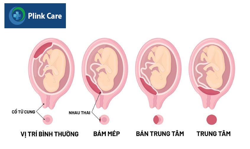 vị trí của rau tiền đạo