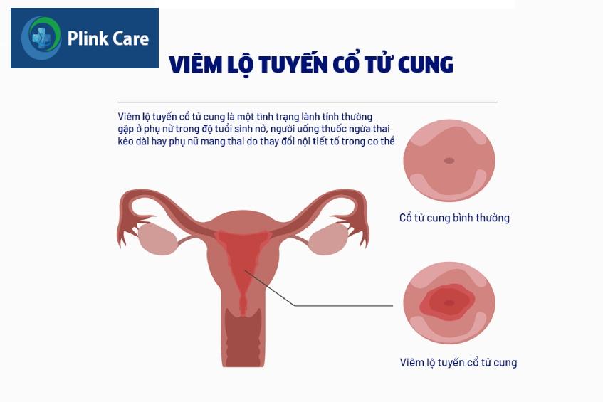 viêm lộ tuyến cổ tử cung là gì