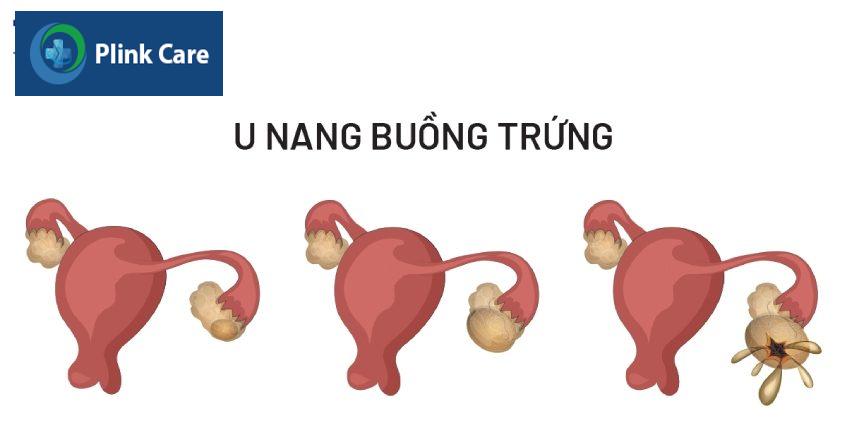vỡ u nang dẫn đến nhiễm khuẩn
