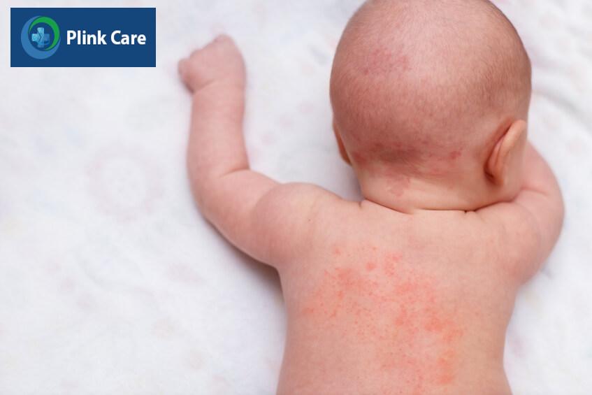 bệnh eczema