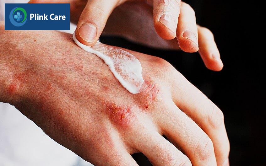 bệnh viêm da cơ địa