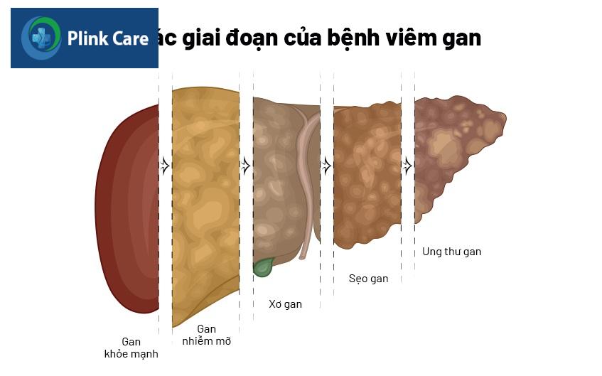 các giai đoạn của viêm gan