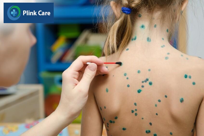 cách chữa bệnh thủy đậu ở trẻ em