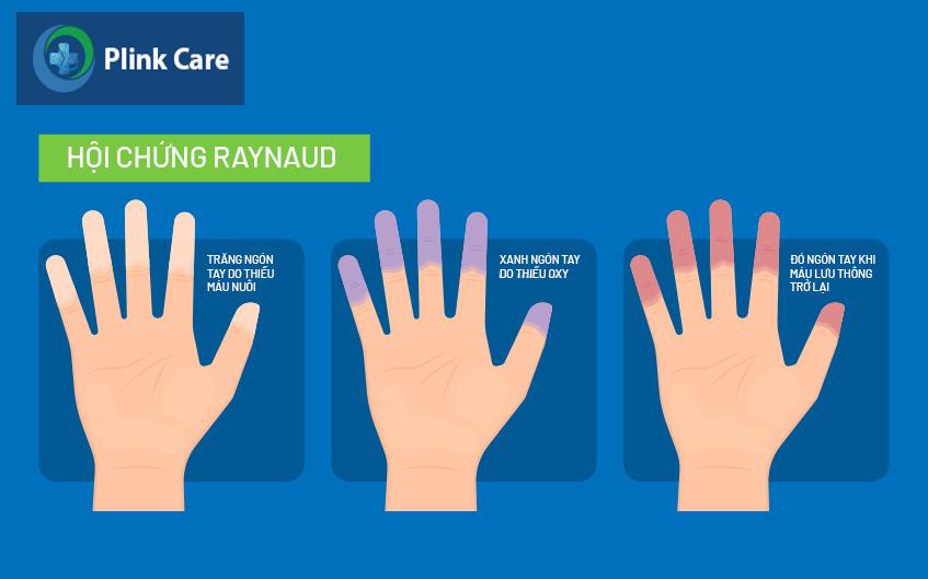 căn bệnh raynaud