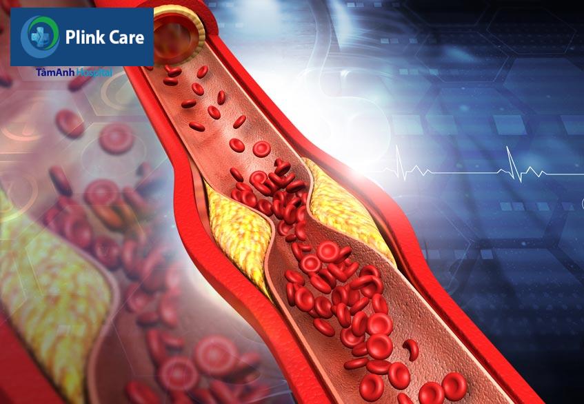 mức cholesterone ldl cao