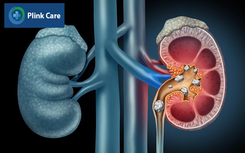 sỏi đường tiết niệu
