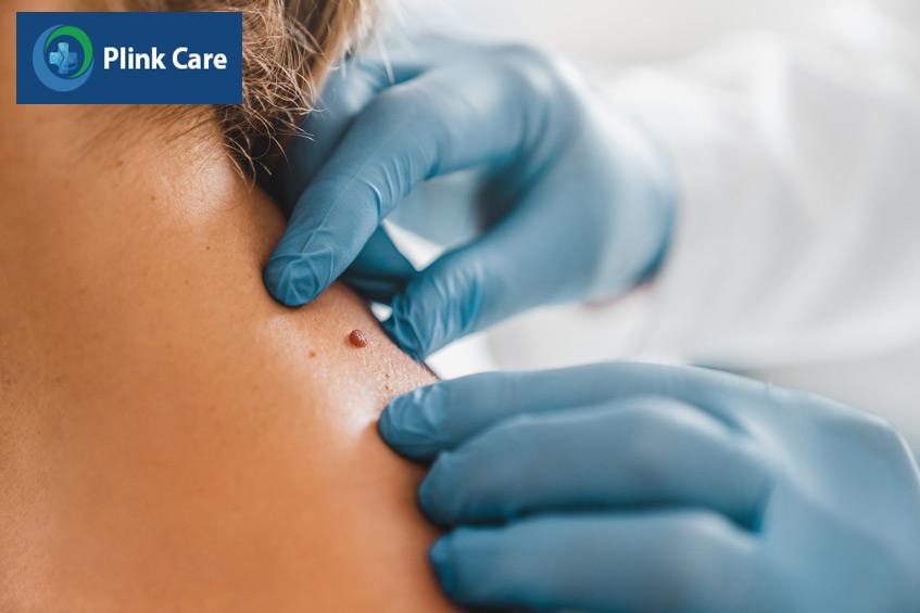 tiếp xúc ánh nắng quá lâu