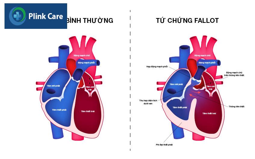 tim bị tứ chứng fallot