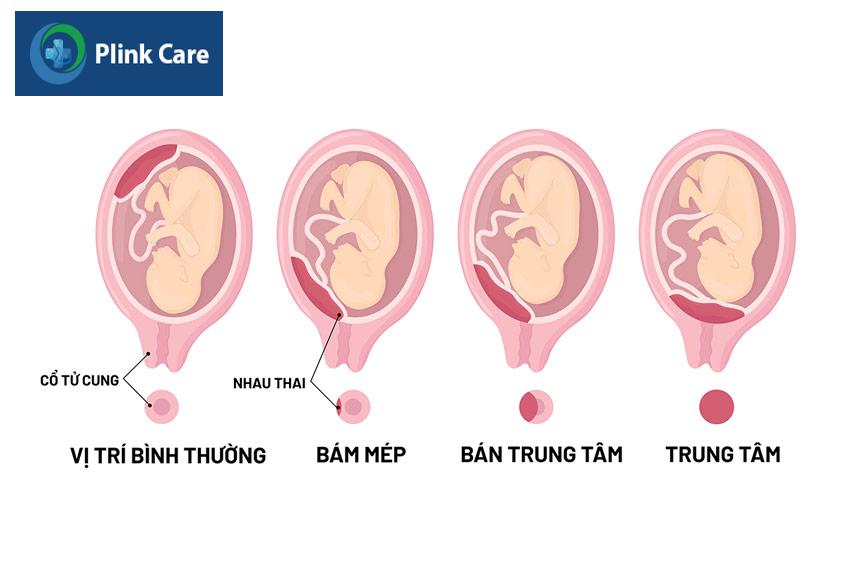 vị trí bám của rau thai