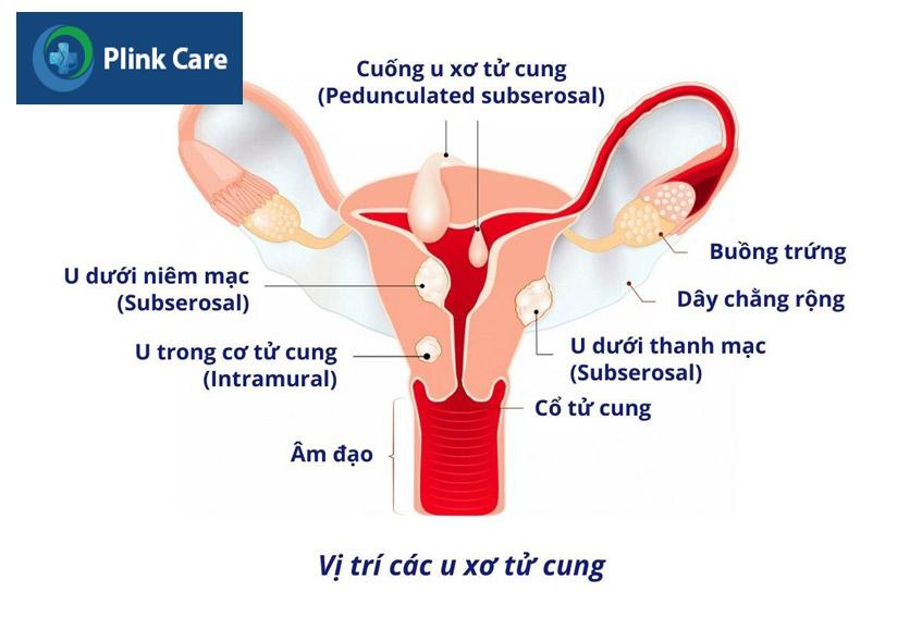 vị trí các khối u xơ trong tử cung