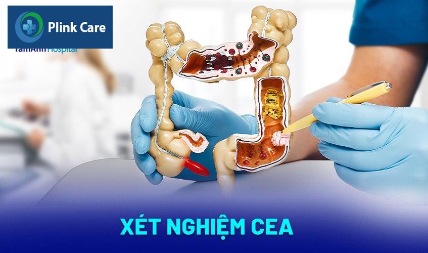 xét nghiệm cea