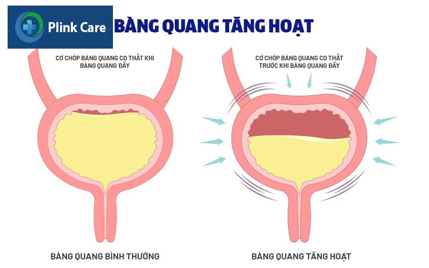 bàng quang tăng hoạt là gì