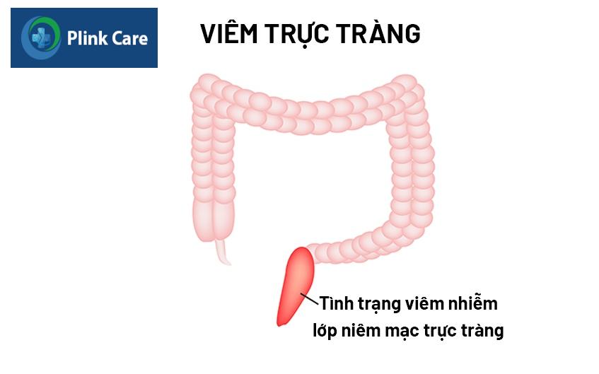 bệnh viêm trực tràng