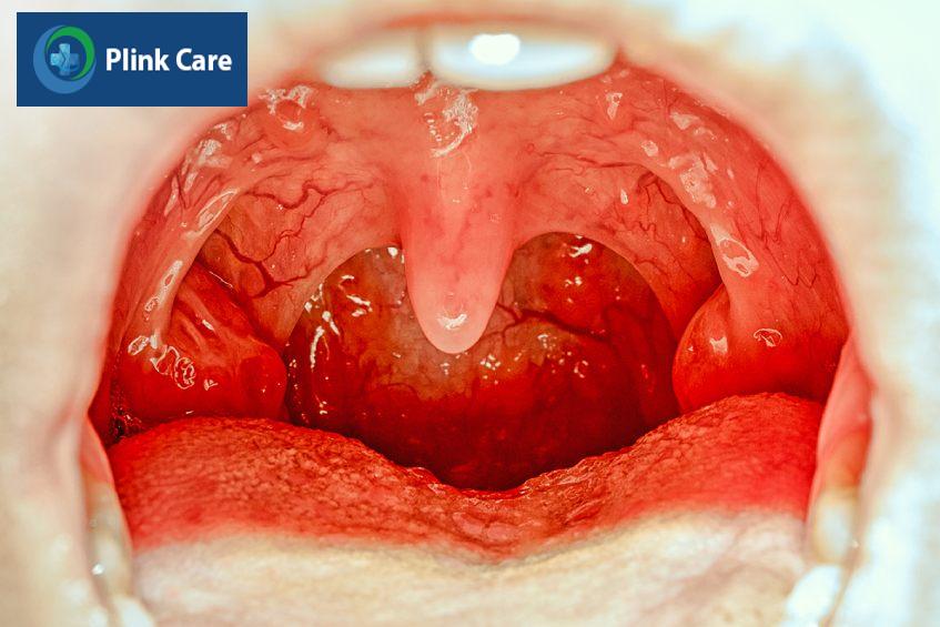 bị amidan có nguy hiểm không