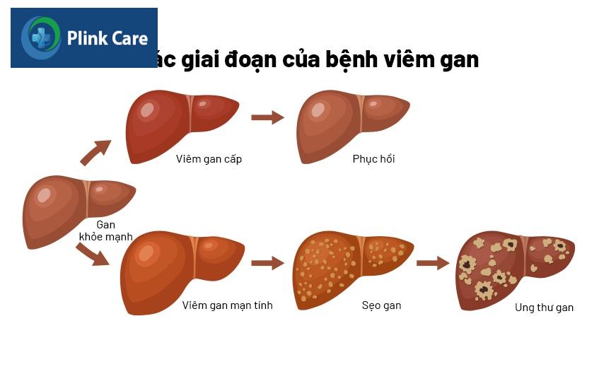 biến chứng gan nhiễm mỡ