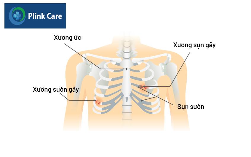 biến chứng khi xương sườn bị gãy